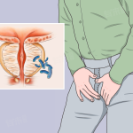 前列腺炎會影響性功能嗎？症狀＋原因＋治療全面分析｜深圳怡康醫院